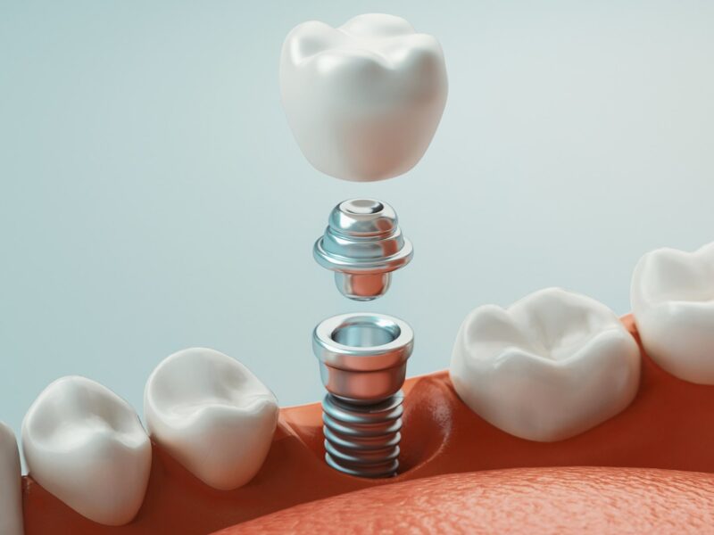 Implantes